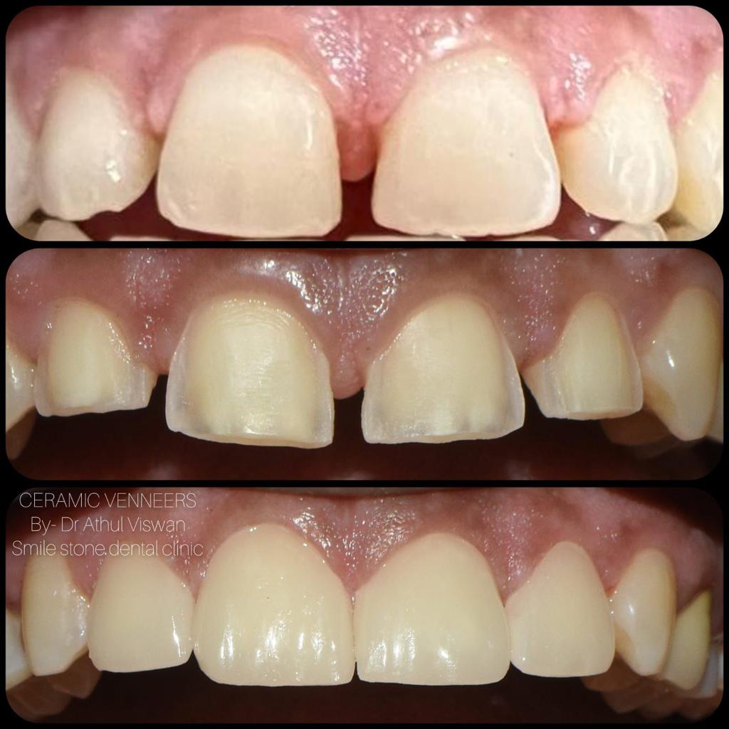 SMILE STONE DENTAL CLINIC CHEVARAMBALAM